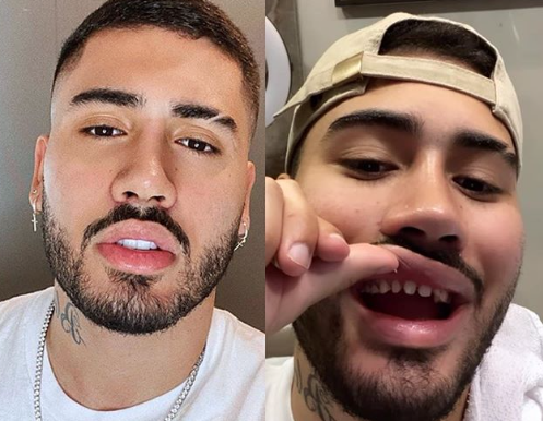 Kevinho tira lentes de contato dos dentes e vira meme na ...