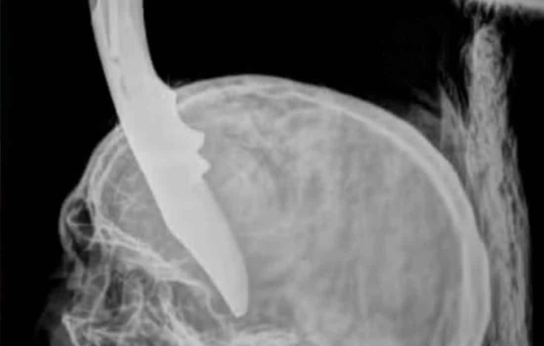 Homem se recupera de cirurgia após ser atingido por canivete na cabeça em Alta Floresta